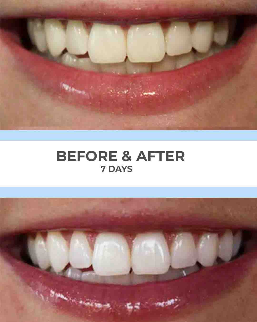 SmilePro before and after results