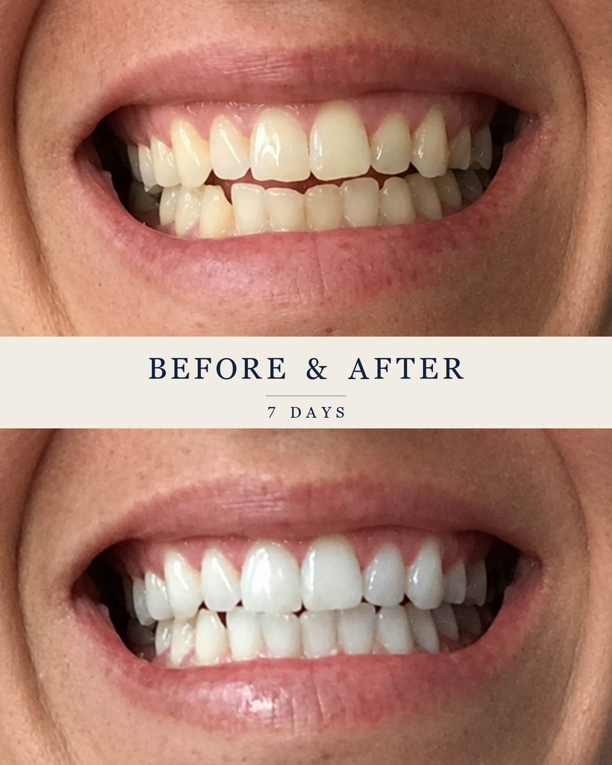 Close-up of a customer’s upper front teeth before and after seven days with the SmilePro Advanced Whitening Kit.