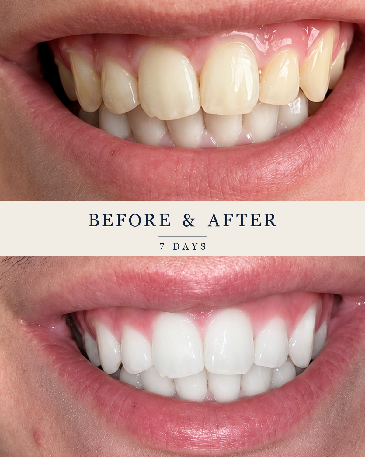 A customer’s full smile before and after a seven-day course of SmilePro whitening treatments.