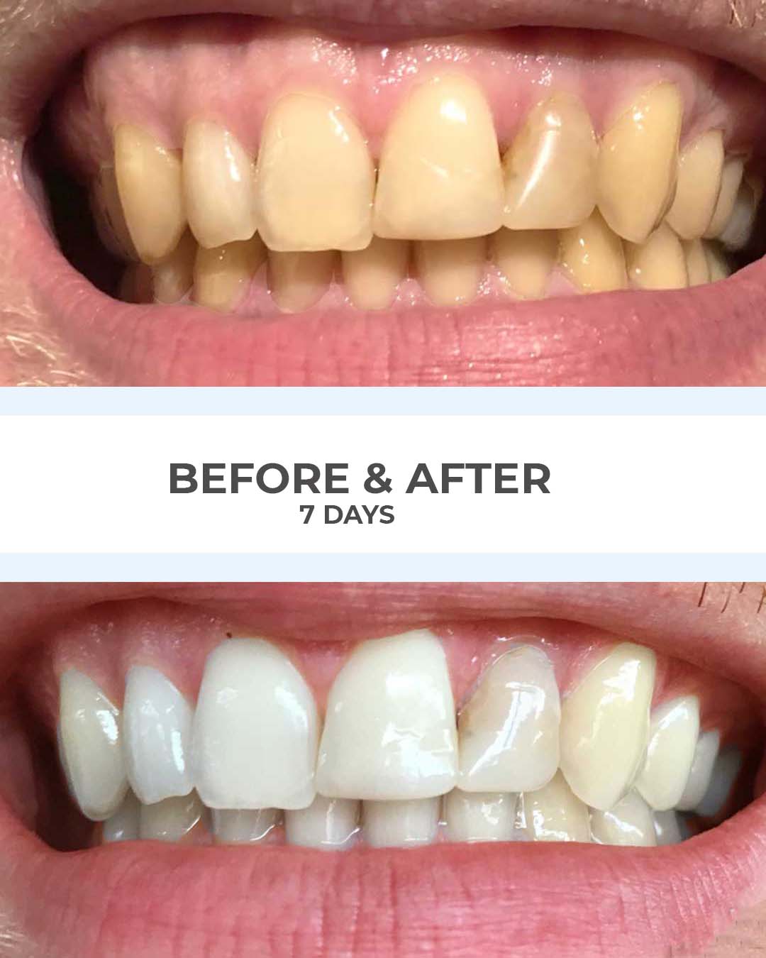 SmilePro before and after results